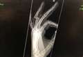X-ray shows how Caley Thistle goalkeeper played through pain barrier